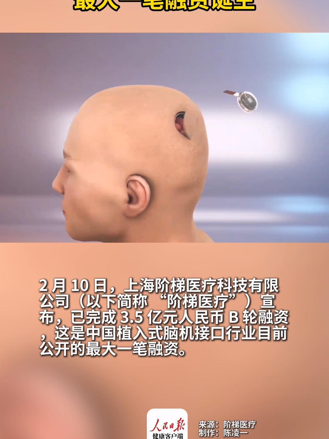 我国首例侵入式脑机接口临床试验成功